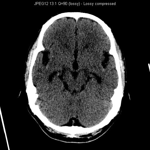 CT Brain - 2